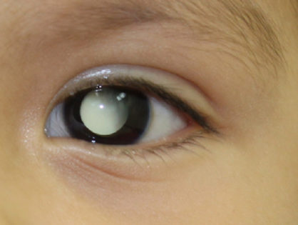 Signos de tumores en los ojos