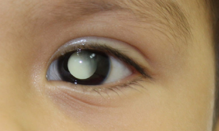 3 signos importantes para sospechar tumores en los ojos de los niños.